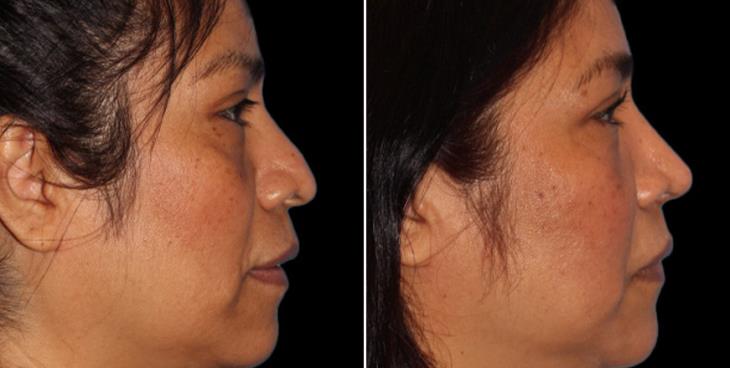 Results Of Open Rhinoplasty In Atlanta Right View